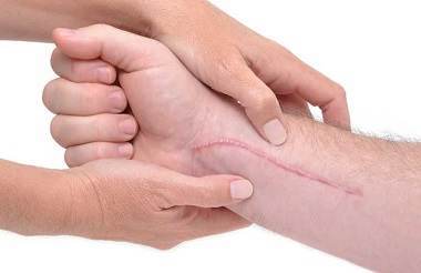 Scars: Prevention and Treatment