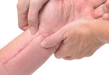 Scars – What Causes Them?