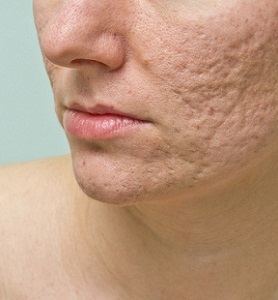 Skin Restoration Treatment