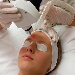 What you need to know about Laser Treatments